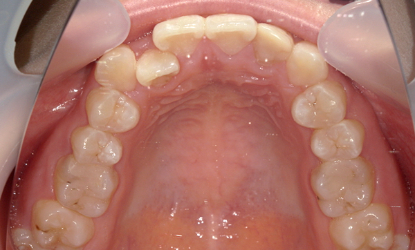 部分矯正 八重歯の症例写真