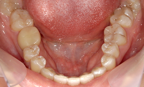 部分矯正 八重歯の症例写真