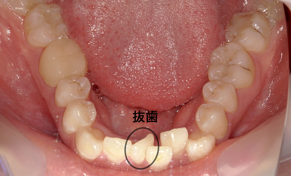 部分矯正 八重歯の症例写真