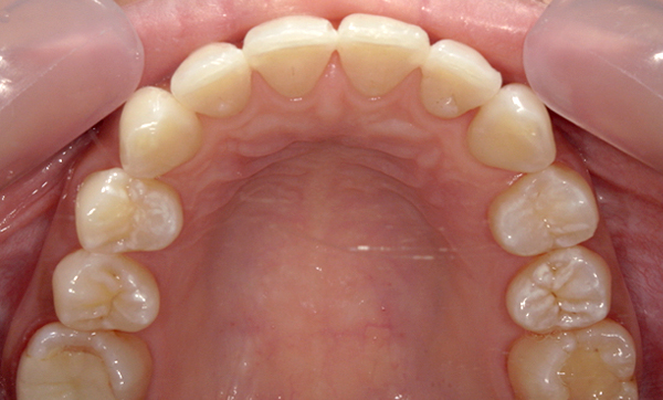 部分矯正 八重歯の症例写真