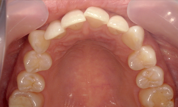 部分矯正 八重歯の症例写真