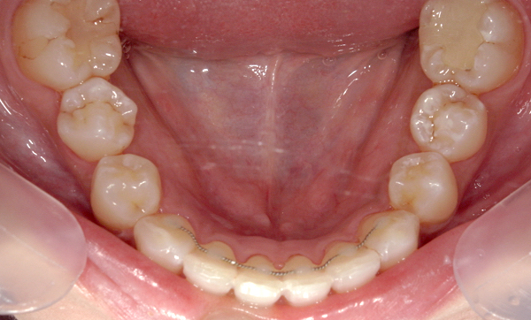 部分矯正 八重歯の症例写真