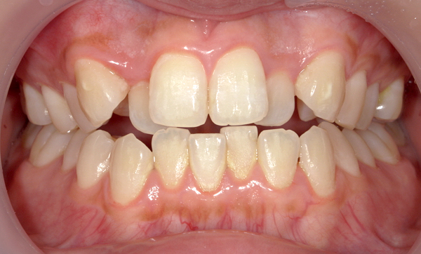 部分矯正 八重歯の症例写真
