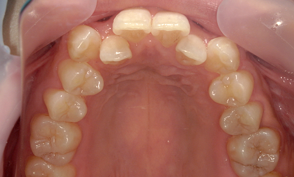 部分矯正 八重歯の症例写真