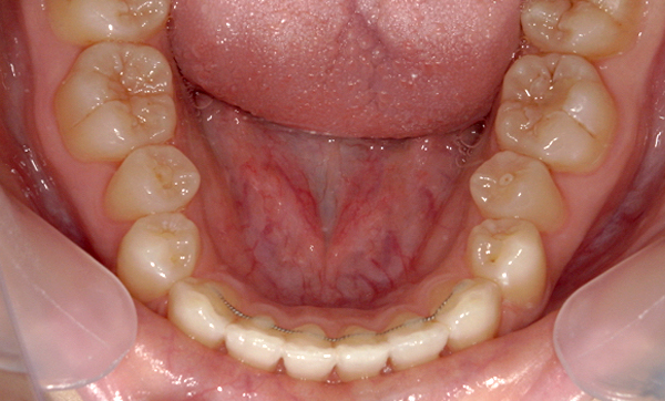 部分矯正 八重歯の症例写真