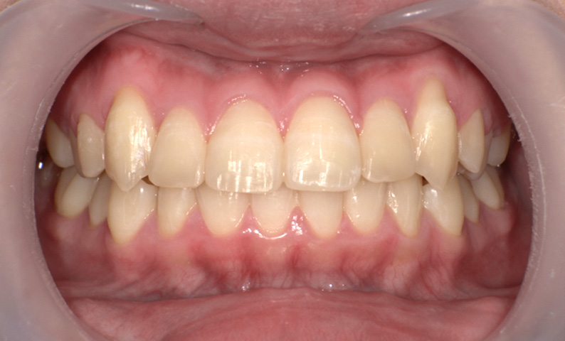 部分矯正 八重歯の症例写真