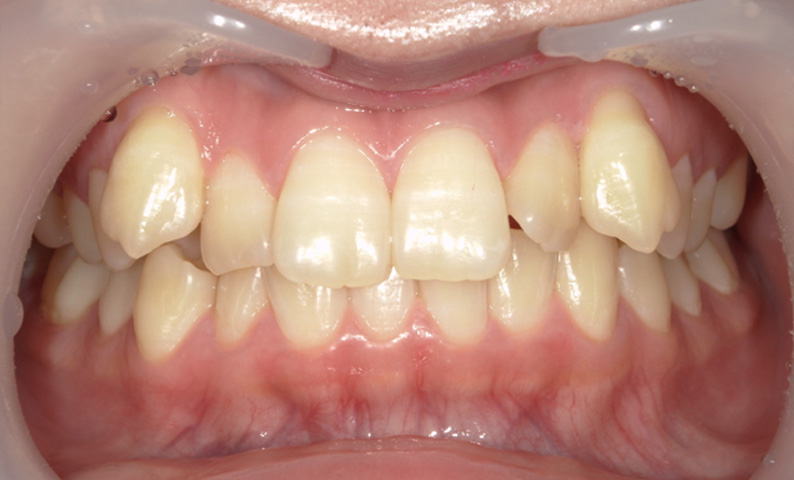 部分矯正 八重歯の症例写真