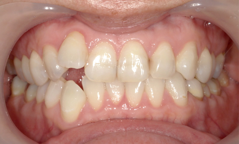 部分矯正 八重歯の症例写真