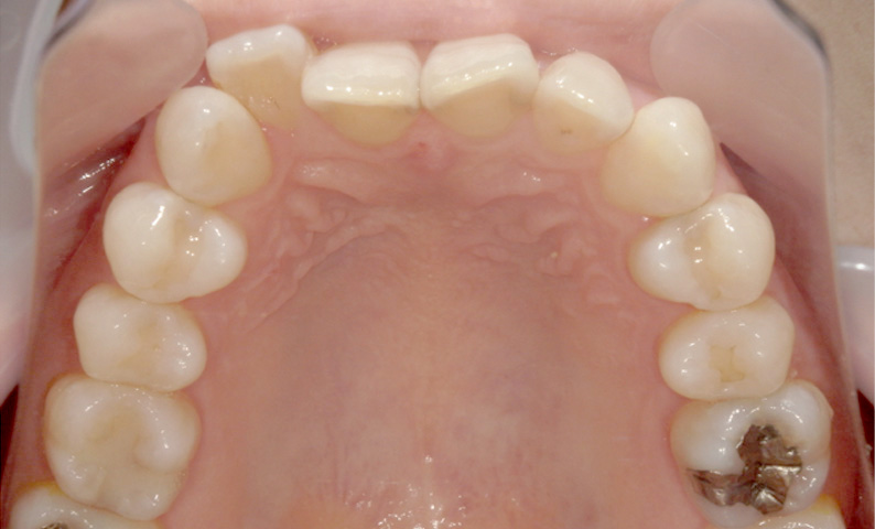 部分矯正 八重歯の症例写真