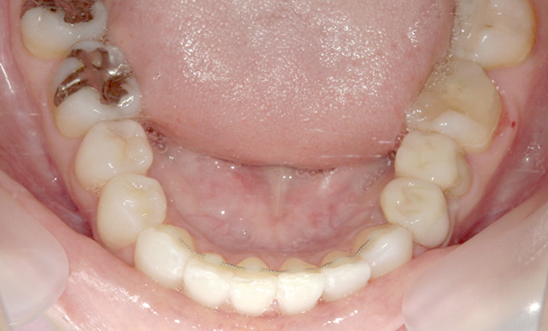 部分矯正 八重歯の症例写真