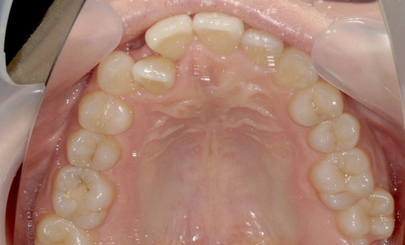 部分矯正 八重歯の症例写真