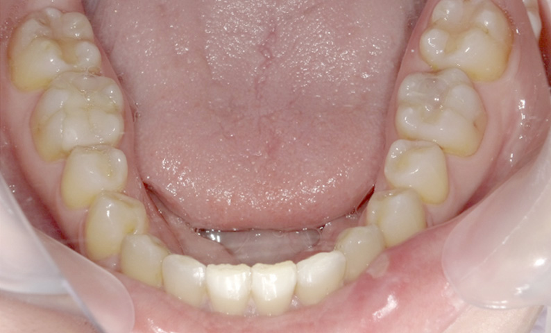 部分矯正 八重歯の症例写真