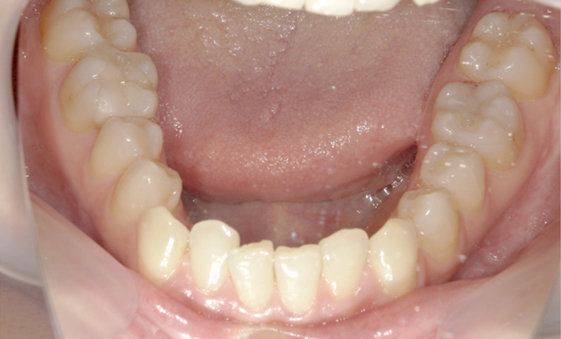 部分矯正 八重歯の症例写真