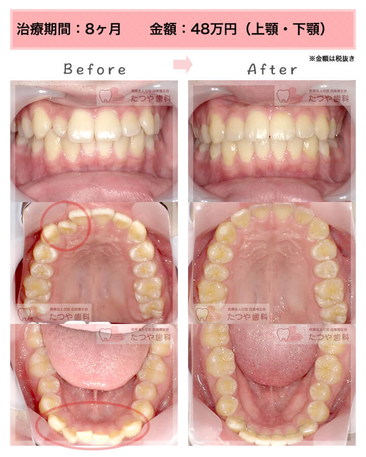 部分矯正の症例　八重歯