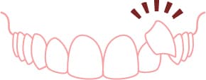 前歯のガタガタ・八重歯