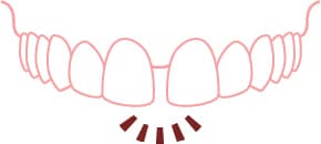 すきっ歯・歯の隙間