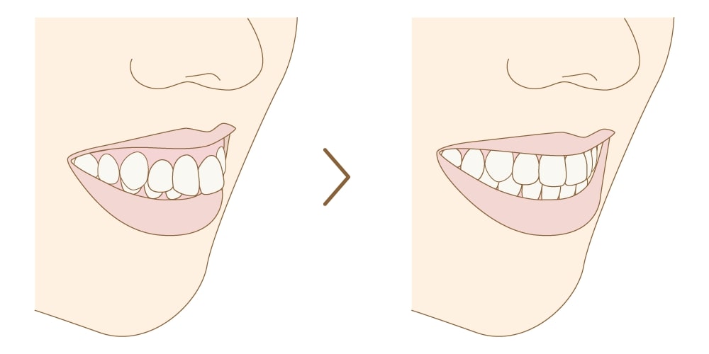 出っ歯と判断される基準