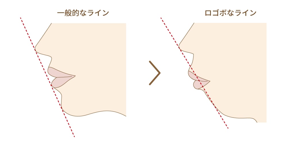 部分矯正では難しい症例