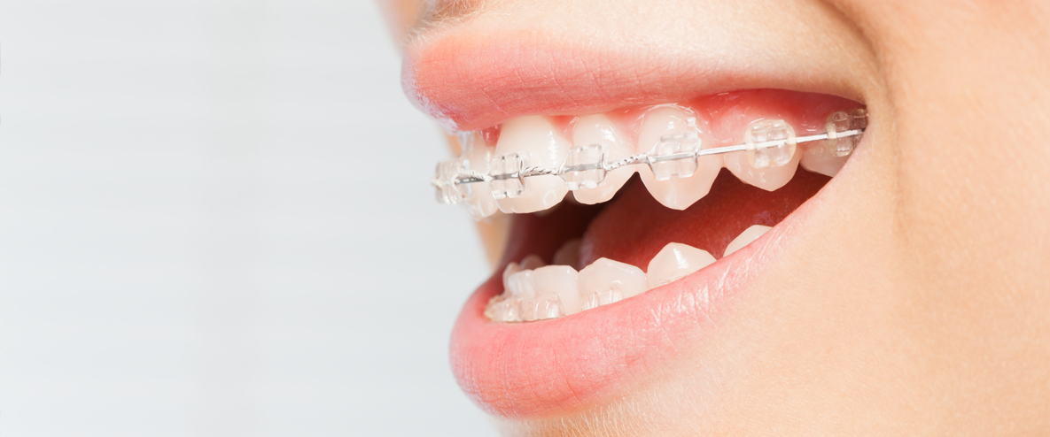 部分矯正のたつや歯科