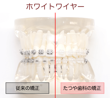 たつや歯科の部分矯正のホワイトワイヤー