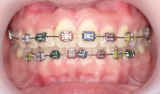 たつや歯科の部分矯正のカラーモジュール：カラーゴム