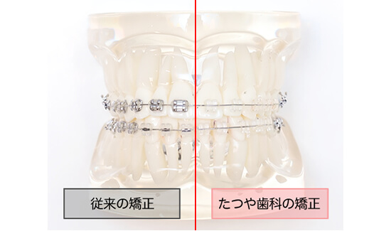 従来の全顎矯正とたつや歯科の部分矯正を比較