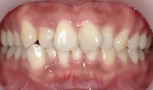たつや歯科の部分矯正_タイプ別症例集_上下の前歯