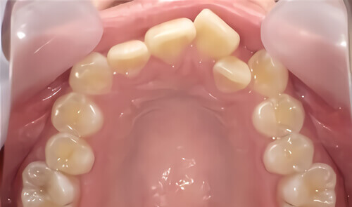 たつや歯科の部分矯正_タイプ別症例集_上の前歯だけ