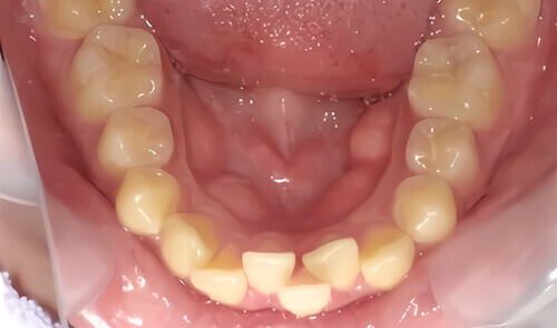 たつや歯科の部分矯正_タイプ別症例集_下の前歯だけ