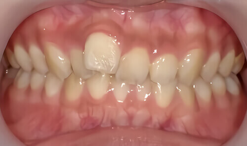 たつや歯科の部分矯正_タイプ別症例集_前歯１本だけ