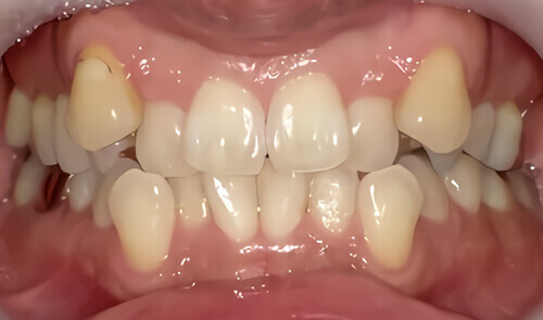たつや歯科の部分矯正_タイプ別症例集_八重歯