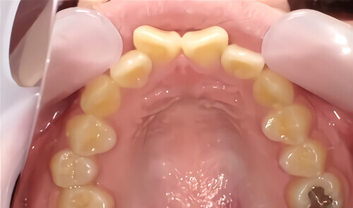 たつや歯科の部分矯正_タイプ別症例集_逆八の字