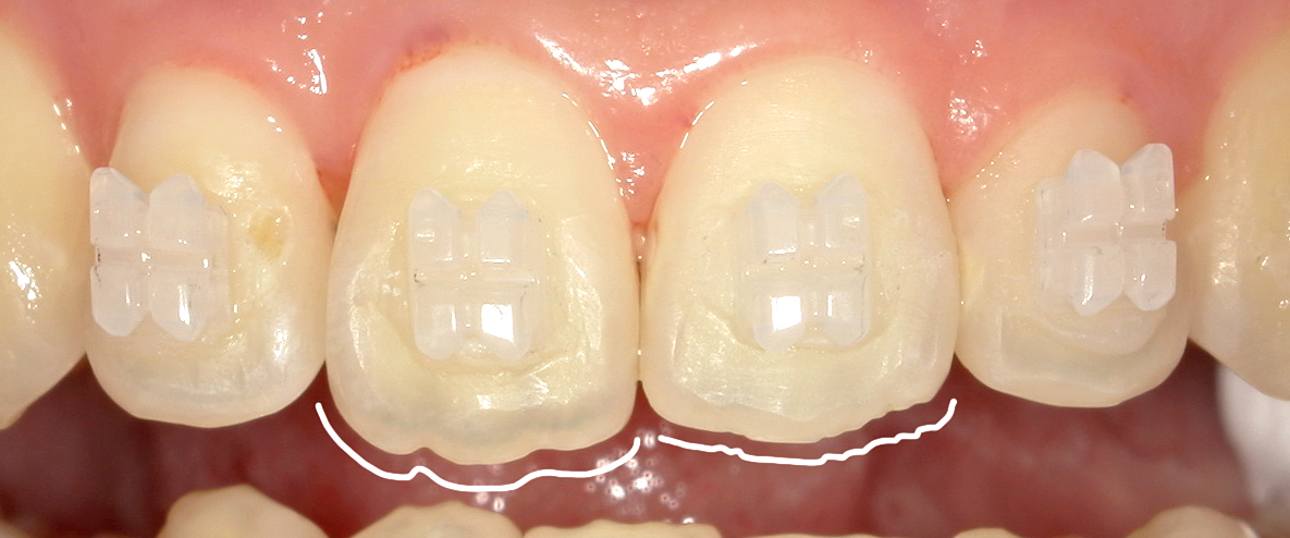 歯の前歯の形態修正