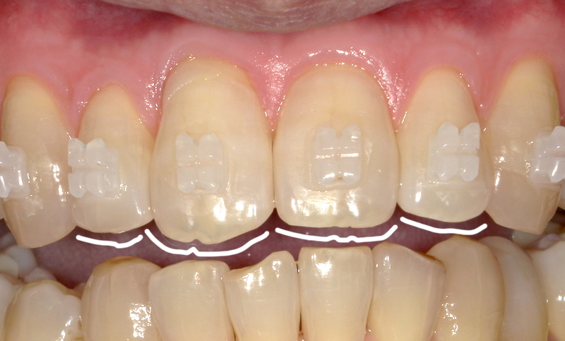 部分矯正 上下の部分矯正の症例写真