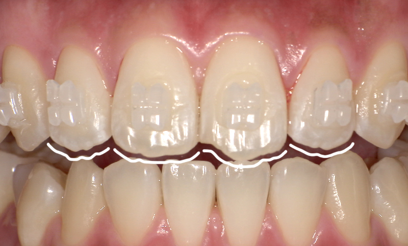 部分矯正 上下の部分矯正の症例写真