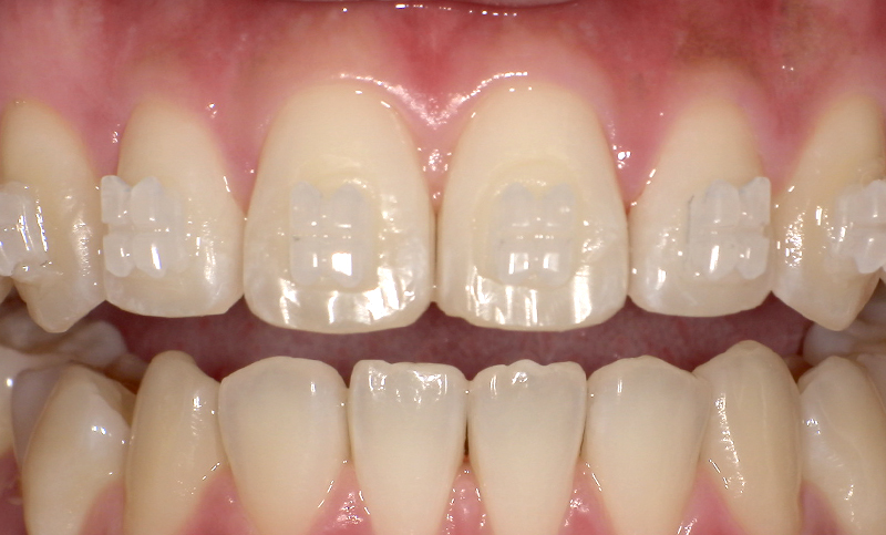 部分矯正 上下の部分矯正の症例写真