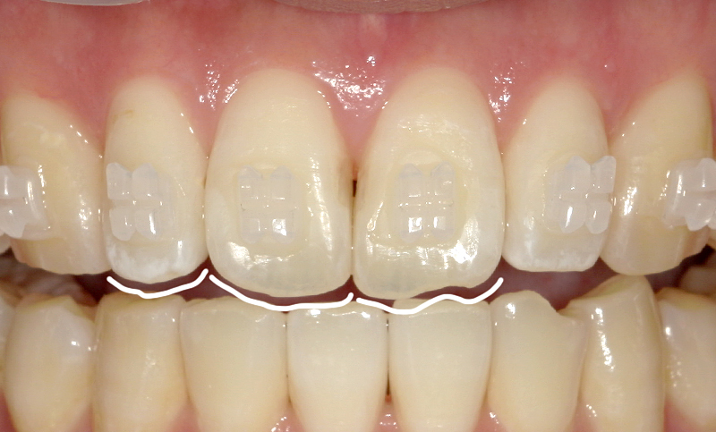 部分矯正 上下の部分矯正の症例写真