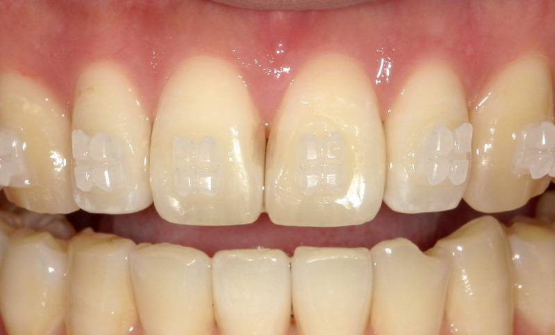 部分矯正 上下の部分矯正の症例写真