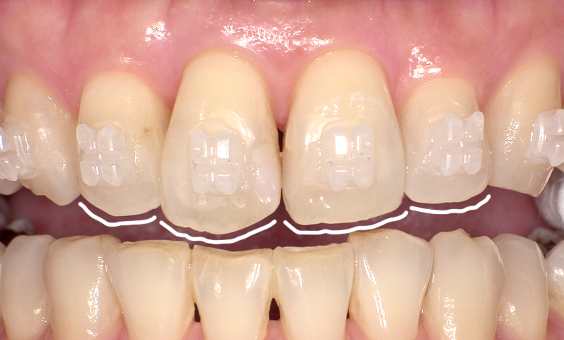 部分矯正 上下の部分矯正の症例写真