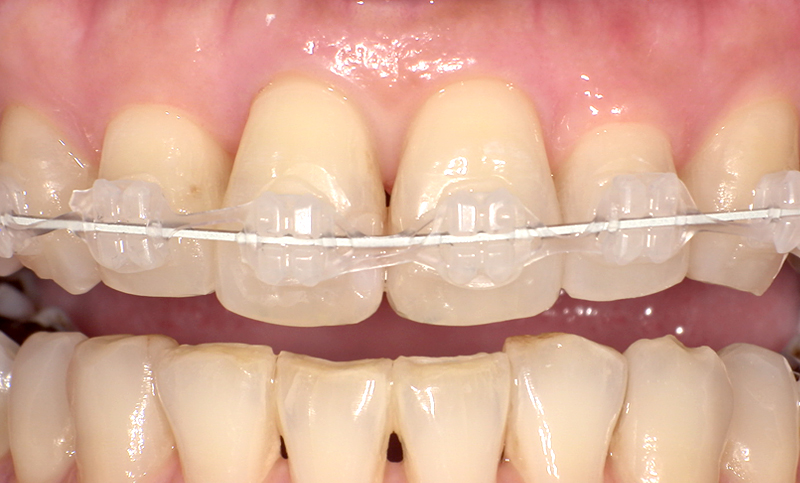 部分矯正 上下の部分矯正の症例写真