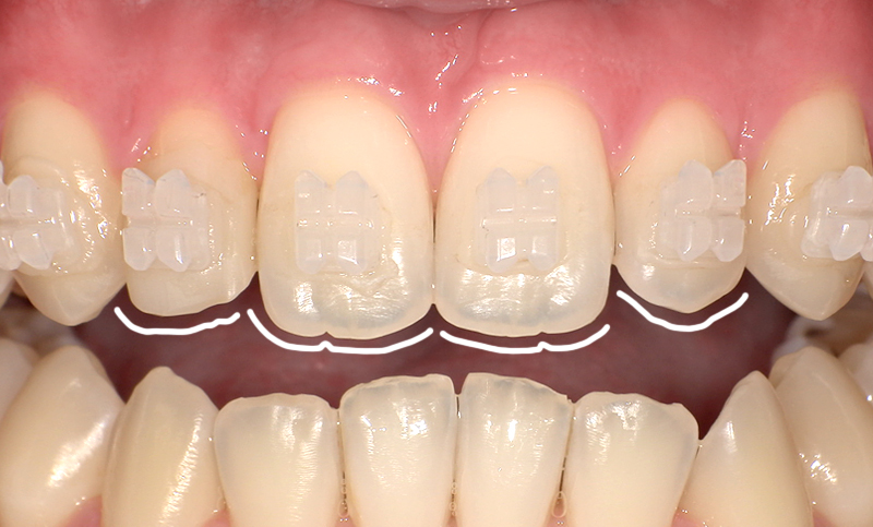 部分矯正 上下の部分矯正の症例写真