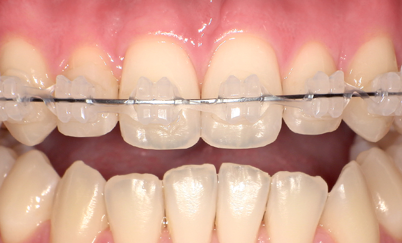 部分矯正 上下の部分矯正の症例写真