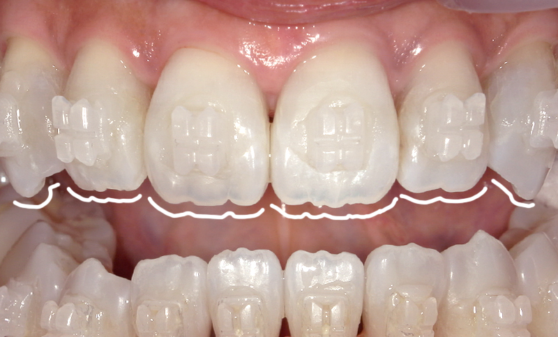 部分矯正 上下の部分矯正の症例写真