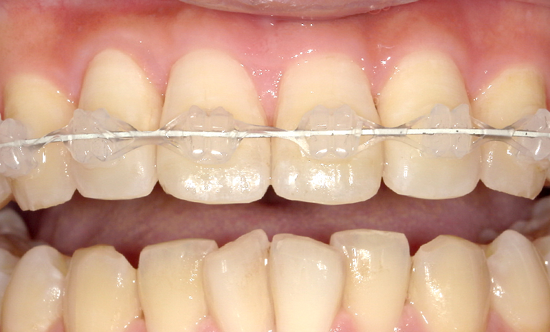 部分矯正 上下の部分矯正の症例写真