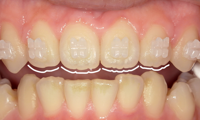 部分矯正 上下の部分矯正の症例写真