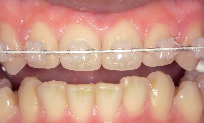 部分矯正 上下の部分矯正の症例写真