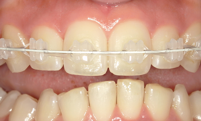 部分矯正 上下の部分矯正の症例写真