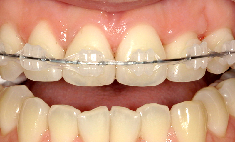 部分矯正 上下の部分矯正の症例写真